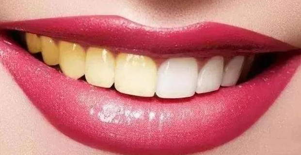 自然美白牙齿的方法有哪些？ 